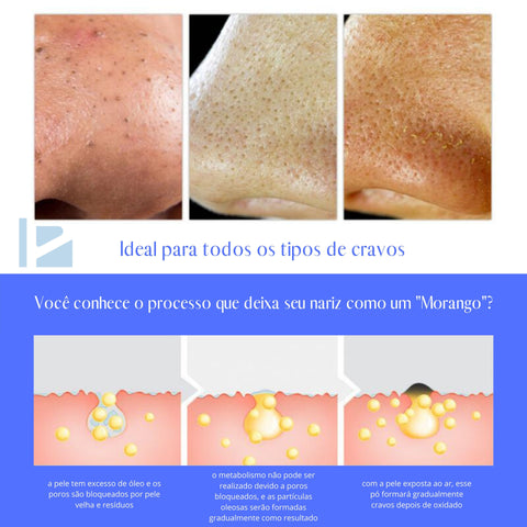 Image of Amolecedor para Remoção de Acne